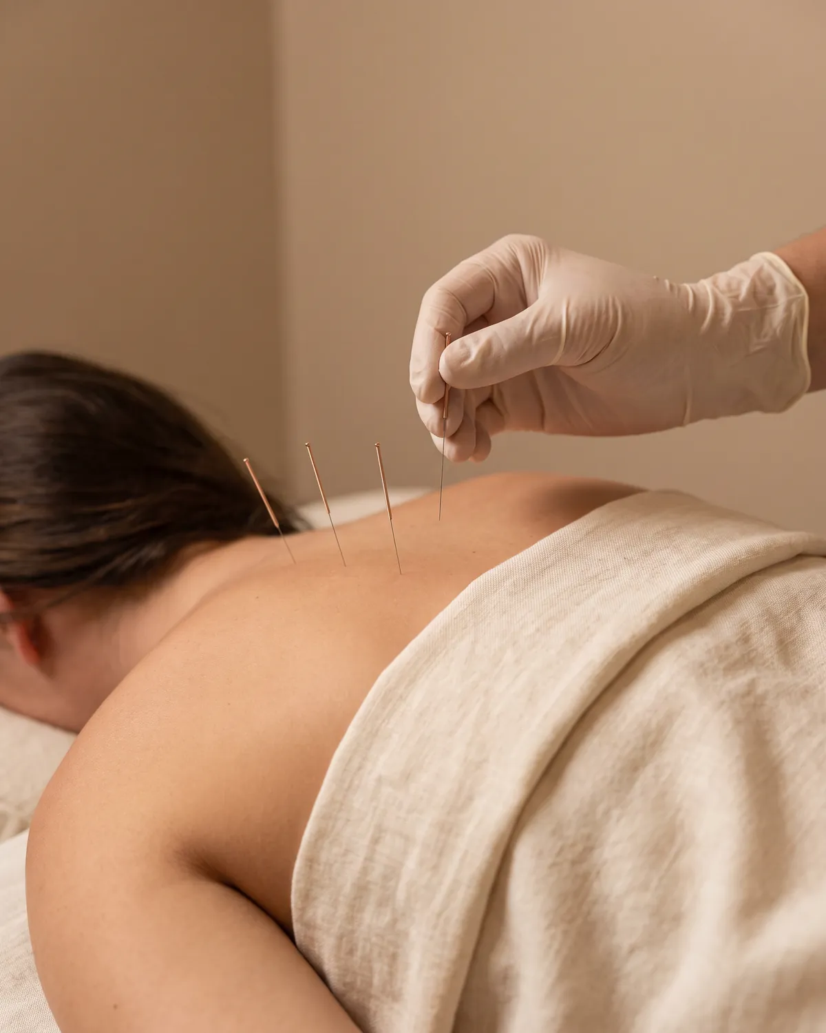 Aiguilles d’acupuncture fines sur le haut du dos